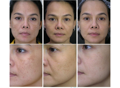 India's first Infrared led mask for skin of your dreams