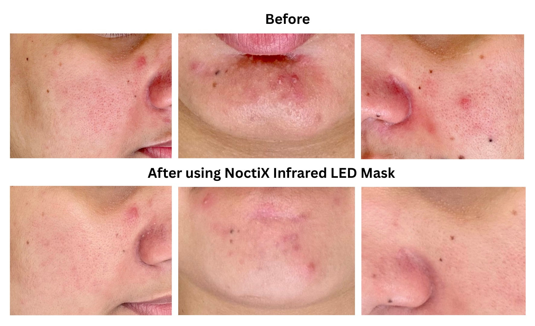 India's first Infrared led mask for skin of your dreams